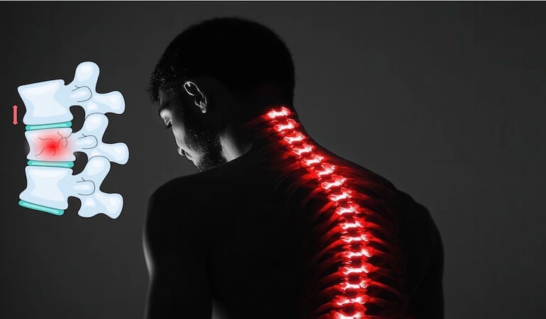 Osteoporoz ve Omurga Kırıklarında Kifoplasti Yönteminin Önemi